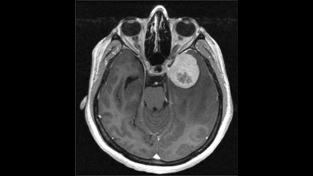 رصد الأورام الدماغية الشرسة‎ - من المصدر